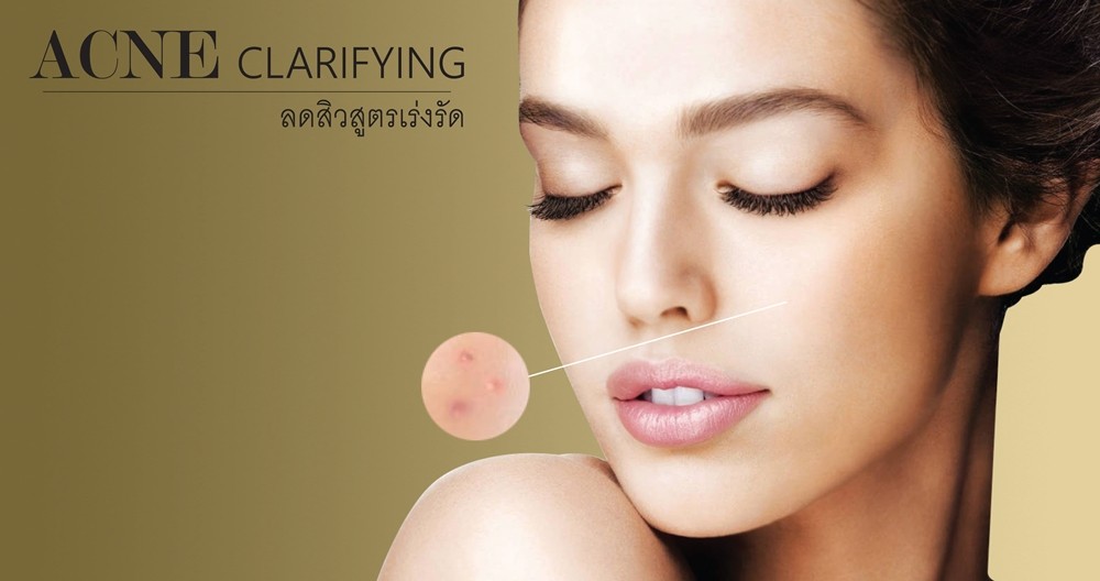 ลดสิว สูตรเร่งรัด